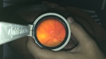  Odocs fundus - smartphone ophthalmoscope  3d model for 3d printers